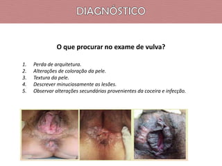 O que procurar no exame de vulva?
1.
2.
3.
4.
5.

Perda de arquitetura.
Alterações de coloração da pele.
Textura da pele.
Descrever minuciosamente as lesões.
Observar alterações secundárias provenientes da coceira e infecção.

 