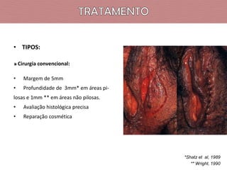 • TIPOS:
» Cirurgia convencional:
•

Margem de 5mm

•

Profundidade de 3mm* em áreas pi-

losas e 1mm ** em áreas não pilosas.
•

Avaliação histológica precisa

•

Reparação cosmética

*Shatz et al, 1989
** Wright, 1990

 