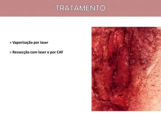 » Vaporização por laser
» Ressecção com laser e por CAF

 