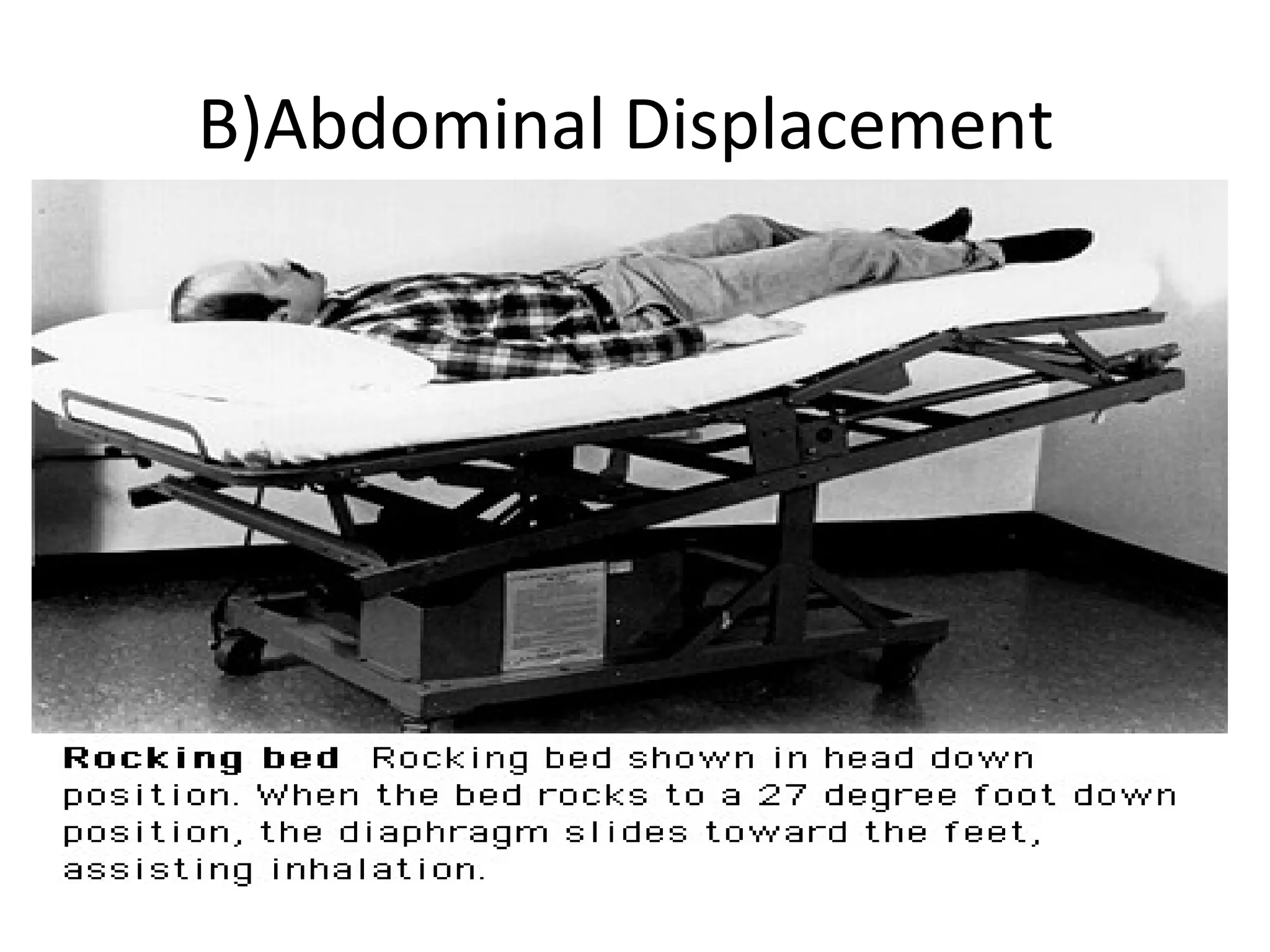 B)Abdominal Displacement
 