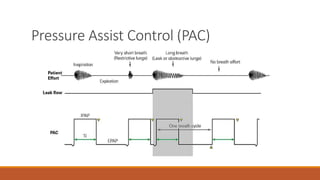 Pressure Assist Control (PAC)
 