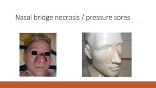 Nasal bridge necrosis / pressure sores
 