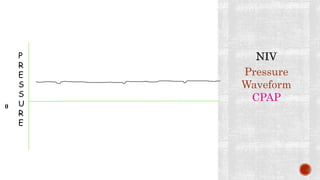 Pressure
Waveform
CPAP
0
P
R
E
S
S
U
R
E
 