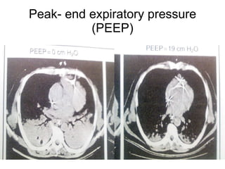 Peak- end expiratory pressure (PEEP) 
