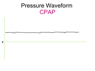 Pressure Waveform  CPAP 0 
