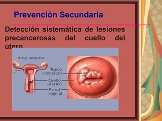 Prevención Secundaria
Detección sistemática de lesiones
precancerosas del cuello del
útero.
 