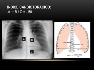 INDICE CARDIOTORACICO:
A + B / C = - 50
A B
C
 
