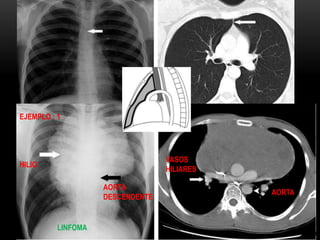 LA LINEA DE UNION ANTERIOR
EJEMPLO : 1
AORTA
DESCENDENTE
HILIO
LINFOMA
VASOS
HILIARES
AORTA
 