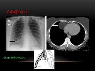 EJEMPLO : 2
GRASA PERICARDICA
 