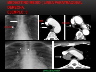 MEDIASTINO MEDIO ( LINEA PARATRAQUEAL
DERECHA.
EJEMPLO :3
SVC
ACIGOS
ACIGOS
LINFADENOPATIA
 