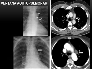 VENTANA AORTOPULMONAR
 