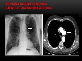 VENTANA AORTOPULMONAR
EJEMPLO: ANEURISMA AORTICO
 