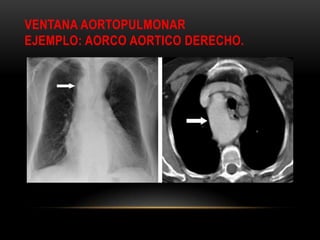 VENTANA AORTOPULMONAR
EJEMPLO: AORCO AORTICO DERECHO.
 