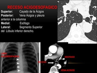 RECESO ACIGOESOFAGICO
Superior: Cayado de la Ácigos
Posterior: Vena Ácigos y pleura
anterior a la columna
Medial: Esófago
Lateral: Segmento Superior
del Lóbulo inferior derecho.
ESOFAGO
RECESO
VENA ACIGOS
LINEA
ACIGOESOFAGICA
 