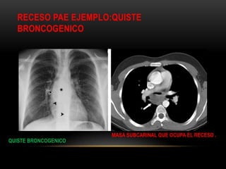 RECESO PAE EJEMPLO:QUISTE
BRONCOGENICO
QUISTE BRONCOGENICO
MASA SUBCARINAL QUE OCUPA EL RECESO .
 