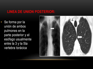 LINEA DE UNION POSTERIOR:
• Se forma por la
unión de ambos
pulmones en la
parte posterior y el
esófago usualmente
entre la 3 y la 5ta
vertebra torácica
 