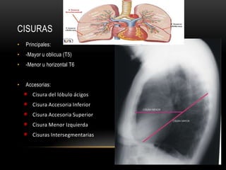 CISURAS
• Principales:
• -Mayor u oblicua (T5)
• -Menor u horizontal T6
• Accesorias:
Cisura del lóbulo ácigos
Cisura Accesoria Inferior
Cisura Accesoria Superior
Cisura Menor Izquierda
Cisuras Intersegmentarias
 