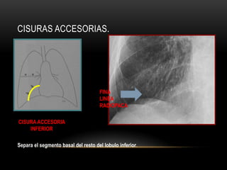 CISURAS ACCESORIAS.
CISURA ACCESORIA
INFERIOR
FINA
LINEA
RADIOPACA
Separa el segmento basal del resto del lobulo inferior.
 