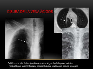 CISURA DE LA VENA ÁCIGOS
Debido a una falla de la migración de la vena ácigos desde la pared torácica
hasta el lóbulo superior hacia su posición habitual en el Angulo traqueo bronquial.
 