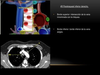 4R Paratraqueal inferior derecho.
• Borde superior: intersección de la vena
innominada con la tráquea.
• Borde inferior: borde inferior de la vena
azigos.
 