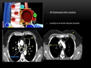 • 4R Paratraqueal inferior izquierdo
• Localiza en el borde traqueal izquierdo
 