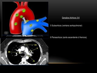 Ganglios Aórticos 5-6
5 Subaorticos (ventana aortopulmonar)
6 Paraaorticos (aorta ascendente ó frenicos)
 