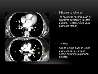 • 9 Ligamento pulmonar
• se encuentra en limites con el
ligamento pulmonar y la pared
posterior e inferior de la vena
pulmonar inferior.
• 10 Hiliar
• se encuentra a nivel de lóbulo
pulmonar izquierdo y por
debajo del bronquio principal
derecho.
 