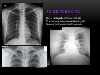 RX DE TORAX PA
Que la radiografía este bien centrada.
El aumento de exposición de la radiografía.
Se debe tomar en inspiración profunda.
Sub- Exposición
 