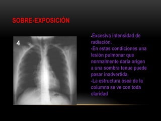 SOBRE-EXPOSICIÓN
-Excesiva intensidad de
radiación.
-En estas condiciones una
lesión pulmonar que
normalmente daría origen
a una sombra tenue puede
pasar inadvertida.
-La estructura ósea de la
columna se ve con toda
claridad
 