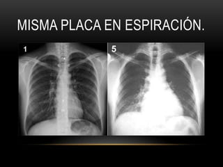 MISMA PLACA EN ESPIRACIÓN.
 