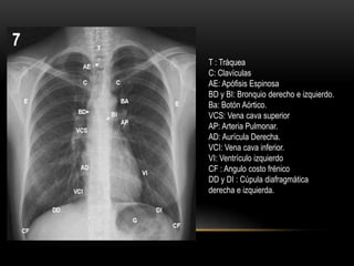 T : Tráquea
C: Clavículas
AE: Apófisis Espinosa
BD y BI: Bronquio derecho e izquierdo.
Ba: Botón Aórtico.
VCS: Vena cava superior
AP: Arteria Pulmonar.
AD: Aurícula Derecha.
VCI: Vena cava inferior.
VI: Ventrículo izquierdo
CF : Angulo costo frénico
DD y DI : Cúpula diafragmática
derecha e izquierda.
 