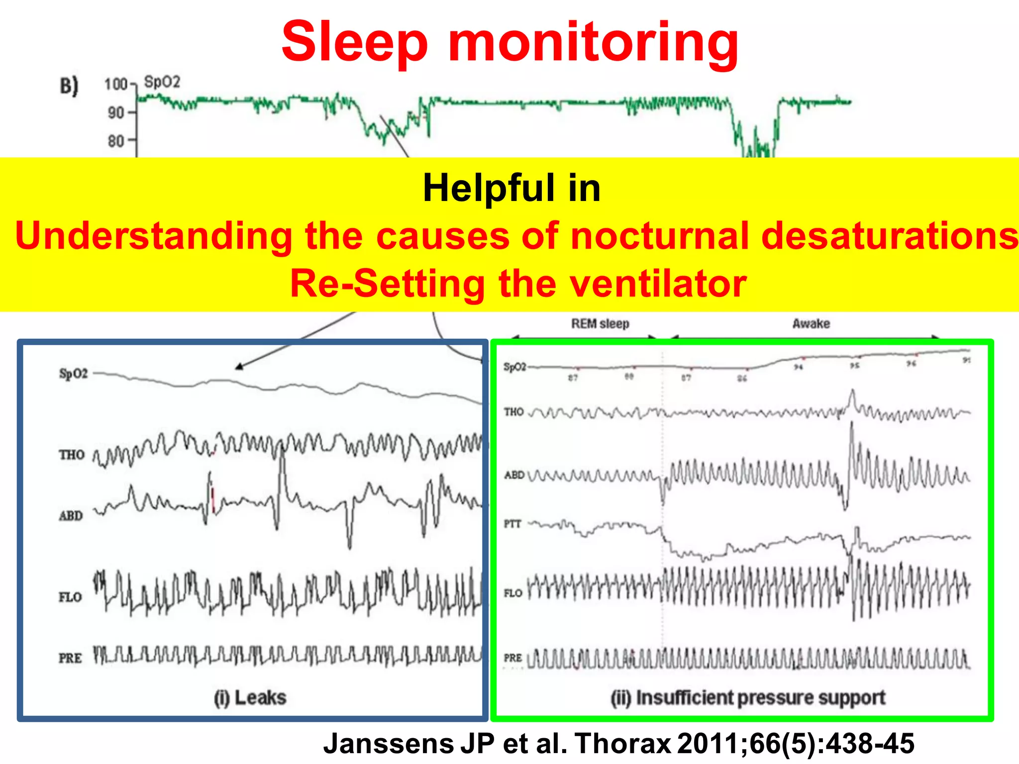 Helpful in
Understanding the causes of nocturnal desaturations
Re-Setting the ventilator
Janssens JP et al. Thorax 2011;66(5):438-45
Sleep monitoring
 