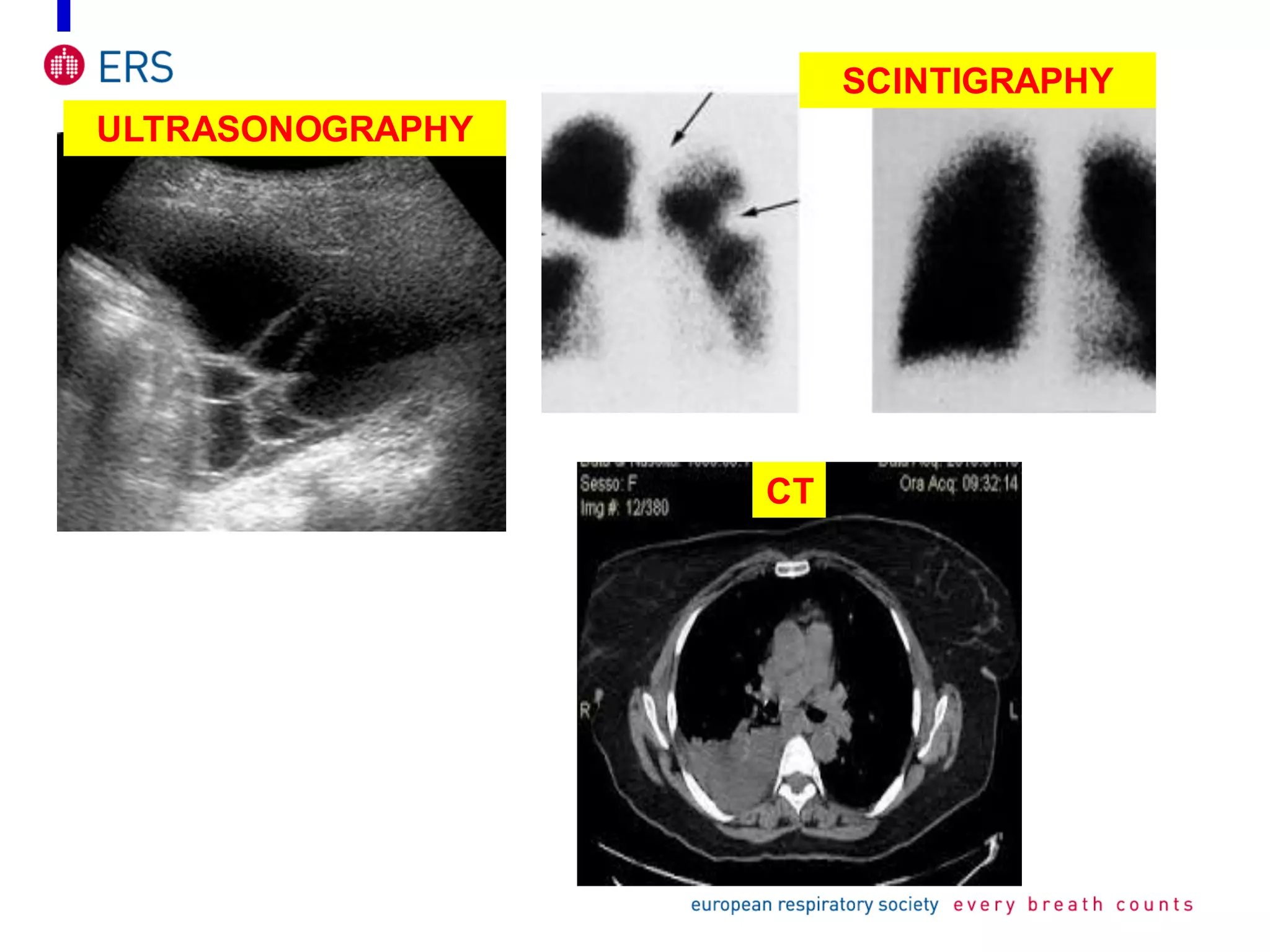 ULTRASONOGRAPHY
CT
SCINTIGRAPHY
 