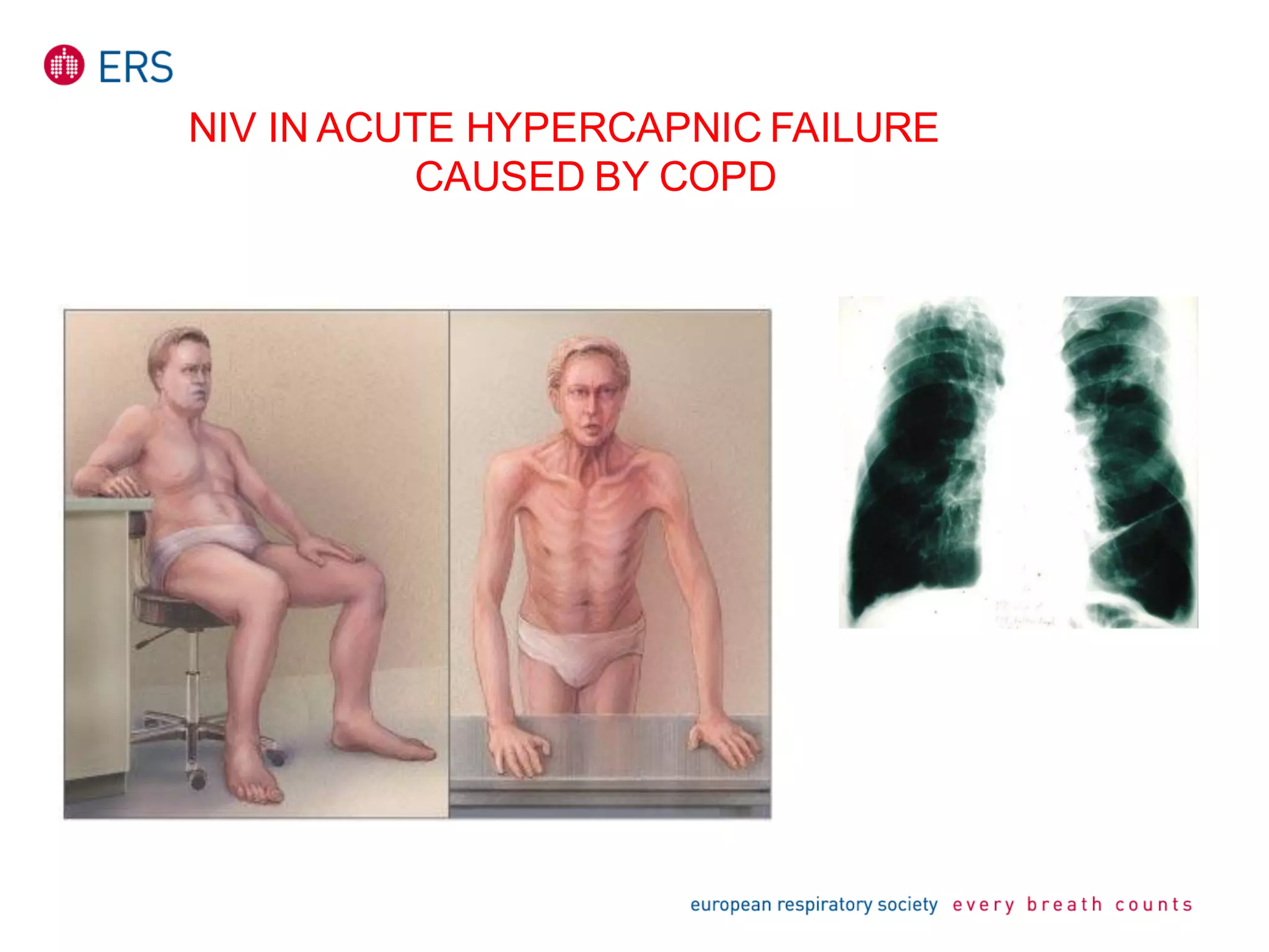 NIV IN ACUTE HYPERCAPNIC FAILURE
CAUSED BY COPD
 