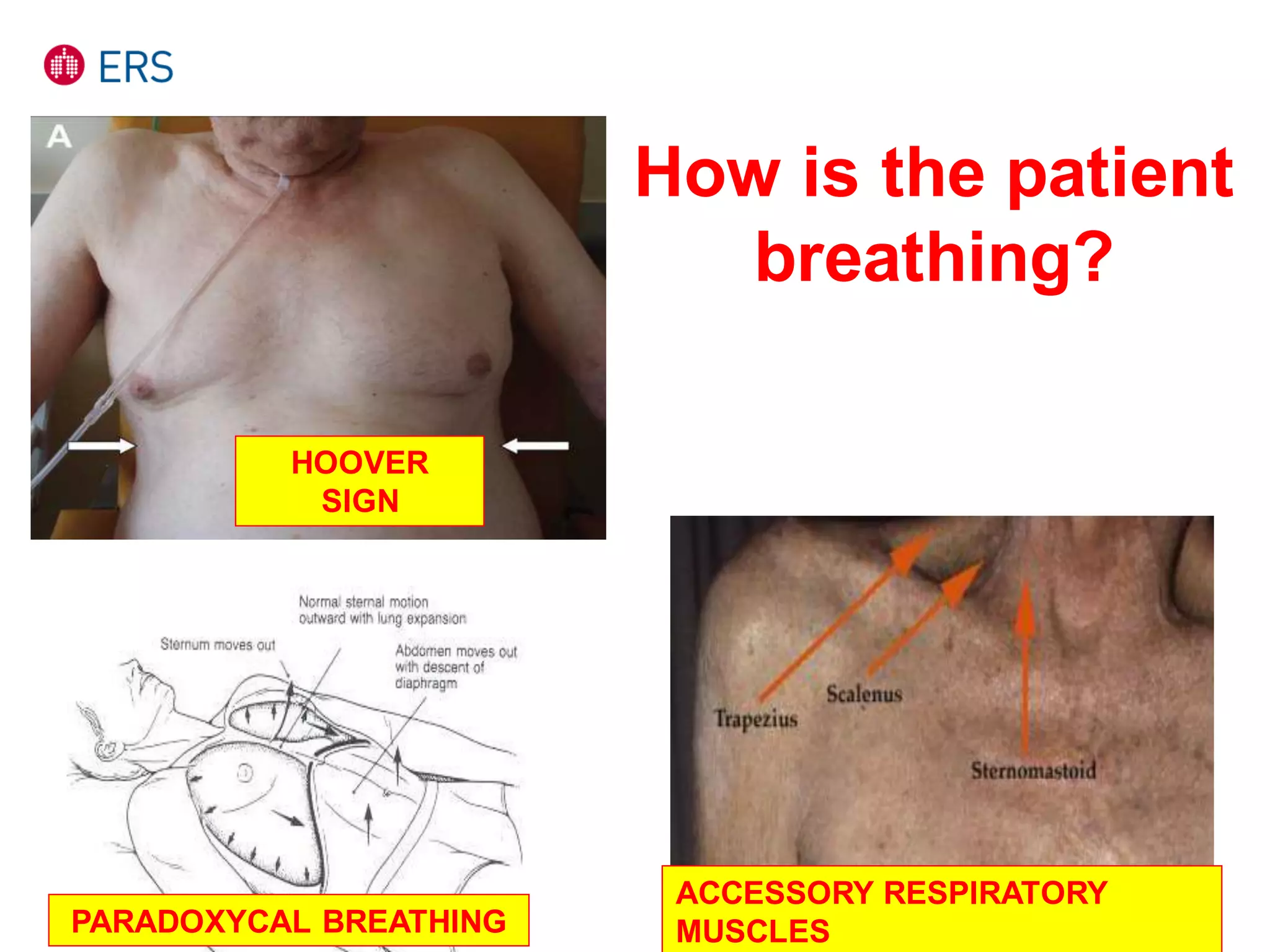 HOOVER
SIGN
ACCESSORY RESPIRATORY
MUSCLESPARADOXYCAL BREATHING
How is the patient
breathing?
 