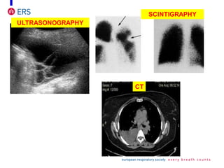 ULTRASONOGRAPHY
CT
SCINTIGRAPHY
 