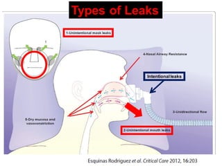 Types of Leaks
Intentionalleaks
 