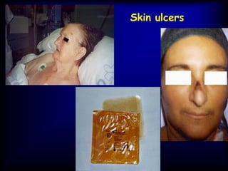 Skin ulcers
 