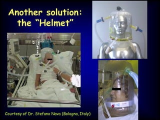 Another solution:
the “Helmet”
Courtesy of Dr. Stefano Nava (Bologna, Italy)
 