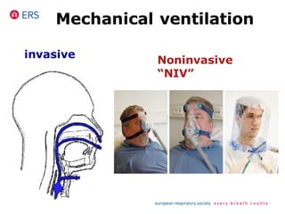 Mechanical ventilation
Noninvasive
“NIV”
invasive
 