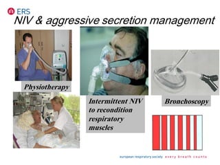 Intermittent NIV
to recondition
respiratory
muscles
Bronchoscopy
Physiotherapy
NIV & aggressive secretion management
 