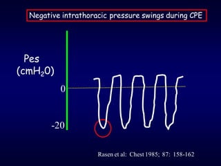 Rasen et al: Chest 1985; 87: 158-162
Negative intrathoracic pressure swings during CPE
Pes
(cmH20)
0
-20
 