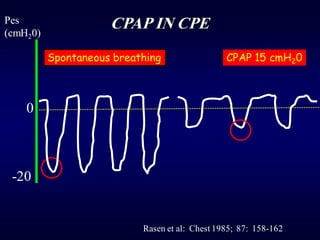 CPAP IN CPE
Rasen et al: Chest 1985; 87: 158-162
Pes
(cmH20)
0
-20
Spontaneous breathing CPAP 15 cmH20
 