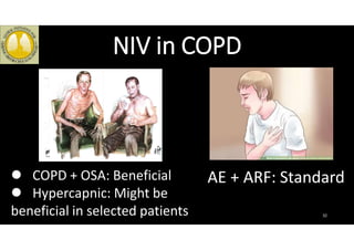NIV in COPD
32
COPD + OSA: Beneficial
Hypercapnic: Might be
beneficial in selected patients
AE + ARF: Standard
 