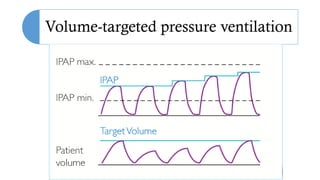 Volume-targeted pressure ventilation
 