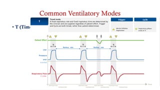 Common Ventilatory Modes
• T (Timed)
 