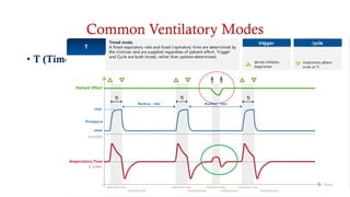 Common Ventilatory Modes
• T (Timed)
 