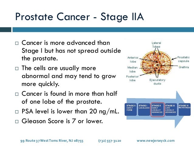 Stages of Prostate Cancer