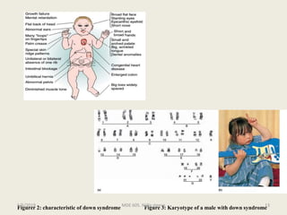 Figurer 2: characteristic of down syndrome Figure 3: Karyotype of a male with down syndromeMDE 605. Njilla steeve 135/5/2019
 