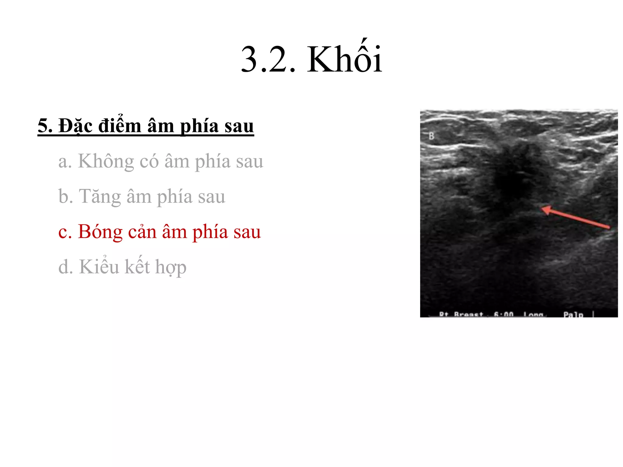3.2. Khối
5. Đặc điểm âm phía sau
a. Không có âm phía sau
b. Tăng âm phía sau
c. Bóng cản âm phía sau
d. Kiểu kết hợp
 